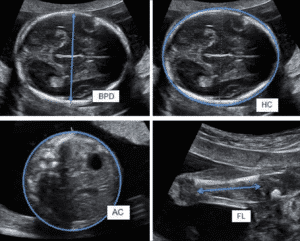 Black and white ultrasound pictures showing different measurements of measuring baby weight highlighted in blue