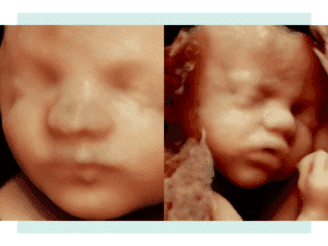 ultrasound image