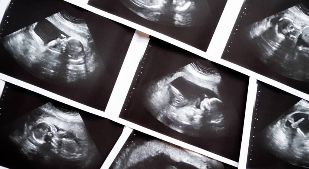 series of ultrasound images Layers of black and white ultrasound images.