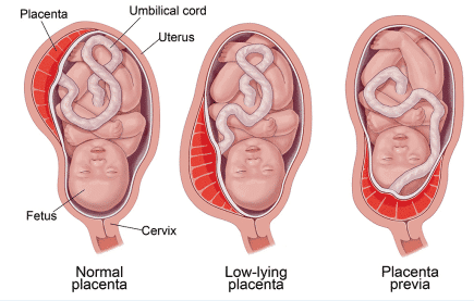 32 week baby ready for delivery with different placenta positions.
