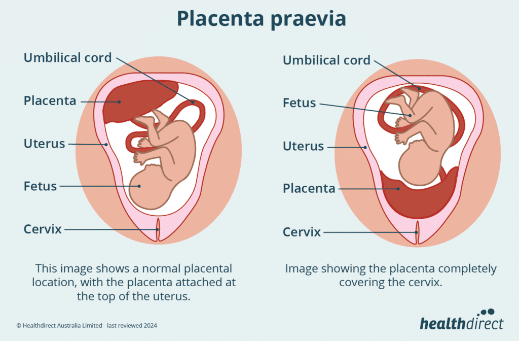 A simplified view of a normal and abnormal placenta.